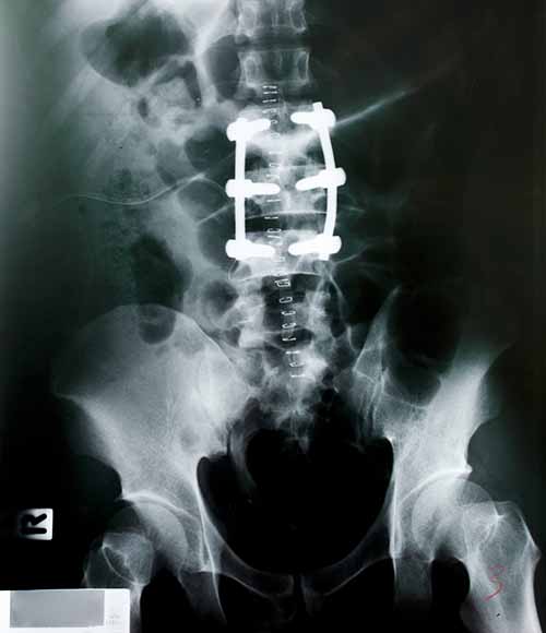 Spinal X-Ray