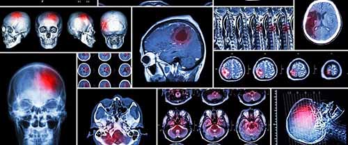 Brain Scan. If you've been injured in an Uber accident, contact Cellino Law for a free case evaluation today. 